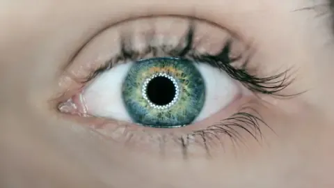 adaptation lentilles de contact